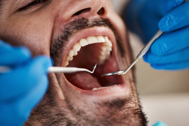 Best Emergency Tooth Extraction in Waco, TX